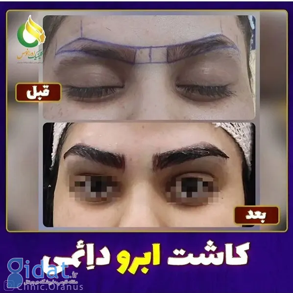 نمونه های کاشت ابرو در کلینیک اورانوس